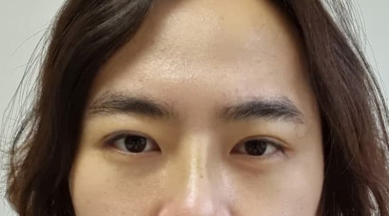 ศัลยกรรมแก้ไขกล้ามเนื้อตาแบบกรีด (ผ่าตัดซ้ำ)