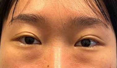 망고트임 (뒤밑트임), 눈밑 지방 재배치