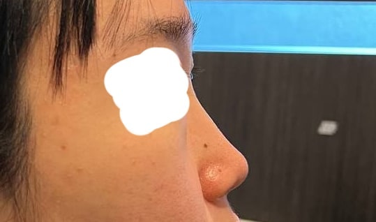 عملية تجميل الأنف المنخفض (+ حقن الدهون في الجبهة)