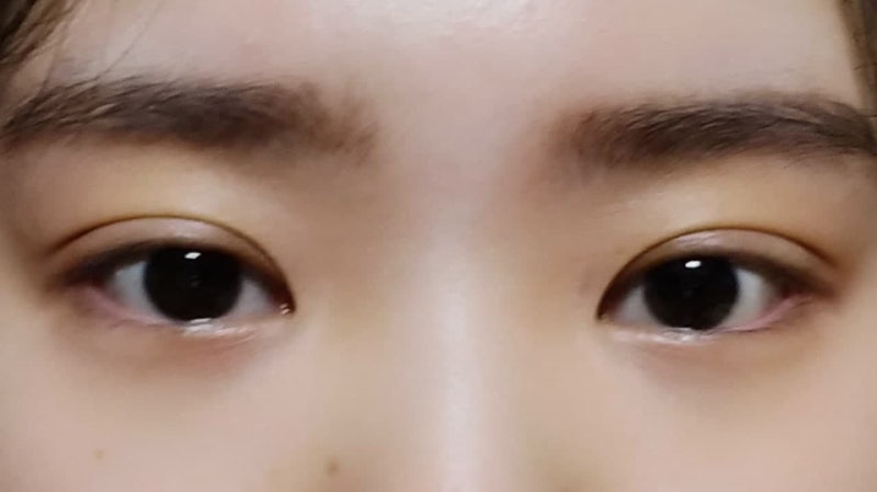 การทำตาสองชั้นแบบเย็บจุดธรรมชาติ (Natural Adhesion)