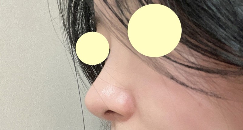 바이브 성형외과 무보형물 코