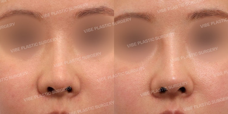 Revision Rhinoplasty Using Autologous Costal Cartilage (+ Functional Rhinoplasty)