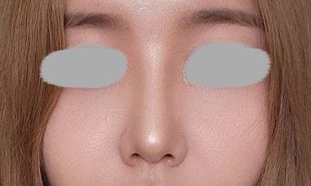 바이브 성형외과의 복코 성형 !