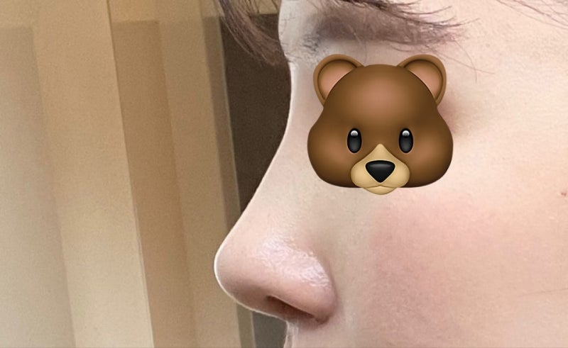 Hoàn thiện dáng mũi thẳng lai tự nhiên nhờ phẫu thuật mũi hếch và thu gọn cánh mũi!