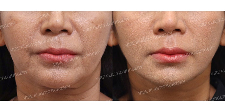 Full Face & Neck Lift (High SMAS Lifting & Double Chin Muscle Tightening)