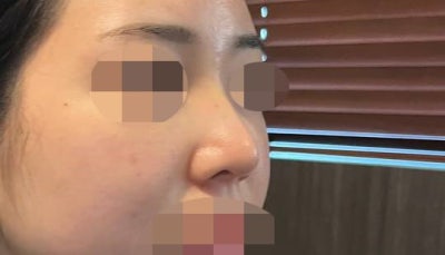 Nose Surgery After Removing Hiko Threads!