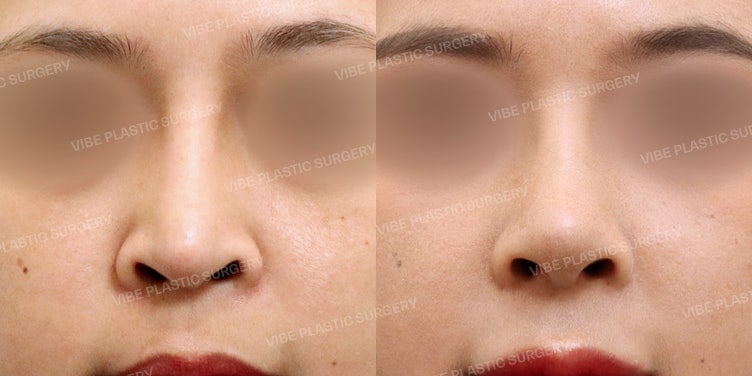 Revision Rhinoplasty for Dragon Nose Caused by Implants