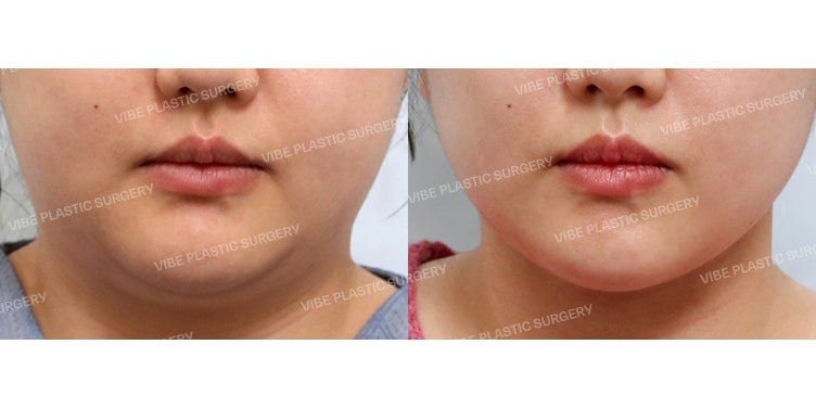 VIBE's Jawline Triple Set: Amazing Results! (LipoSound + Double Chin Muscle Tightening + Buccal Fat Removal)