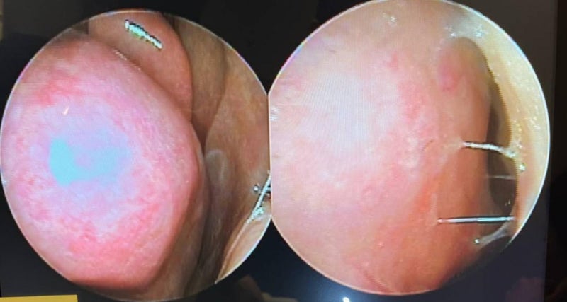 Functional Rhinoplasty with Hump and Deviated Nose Correction!