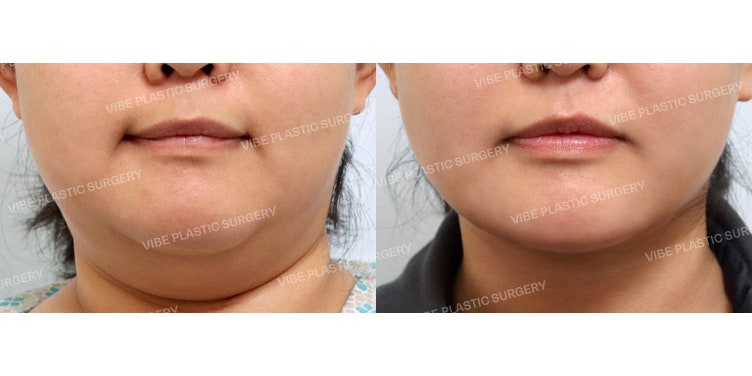 The Amazing Effects of VIBE’s Jawline Trio! (LipoSound + Double Chin Muscle Tying + Buccal Fat Removal)