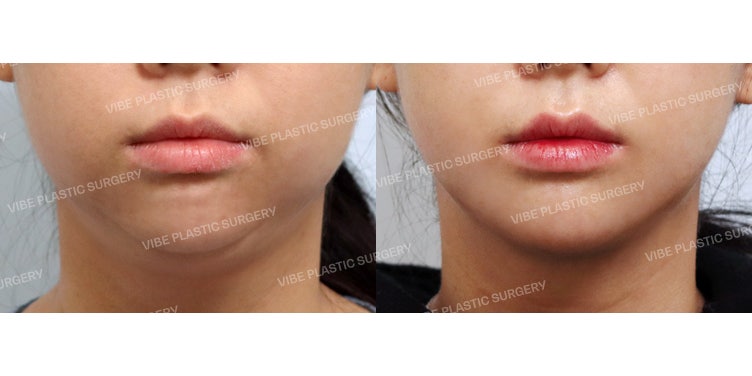 Receding Chin is No Problem! Get a Sharp Jawline at VIBE Plastic Surgery!