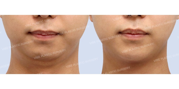 Solving Receding Chin Naturally with Double Chin Muscle Tying - Dr. Young-moon Yoo, VIBE Plastic Surgery