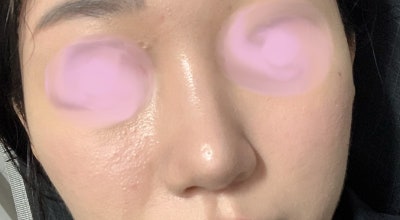 Revision Rhinoplasty for Bulbous and Long Nose with Thick Skin