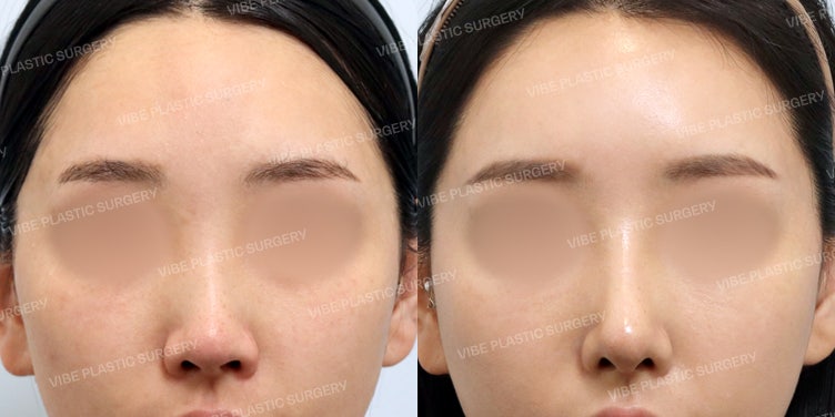 Natural yet Glamorous Straight-Semi-Curved Line Using Autologous Rib Cartilage (+ Functional Rhinoplasty) - Dr. Young-moon Yoo, VIBE Plastic Surgery