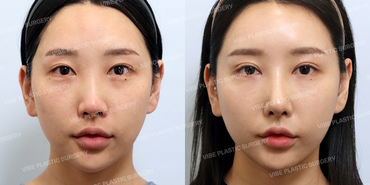หน้ายาวควรทำอย่างไร? คำตอบคือทรงจมูกสโลปปลายพุ่งที่ดูหรูหราและมิติของใบหน้า! (+ ศัลยกรรมจมูกเพื่อการรักษา)