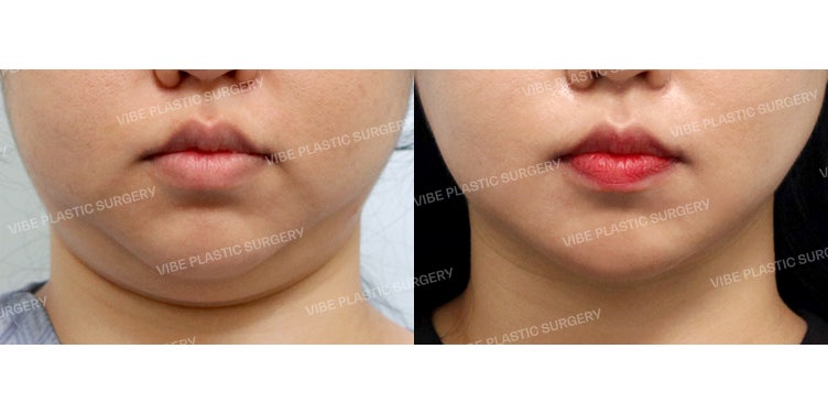 Egg Face Line 3-Step Set จาก VIBE Plastic Surgery!
