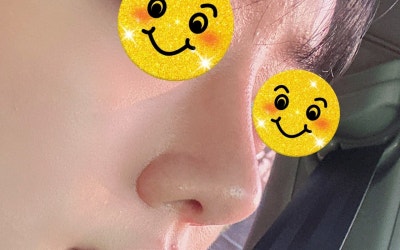 ทำไมการทำจมูกทรงชมพู่ที่มีผิวหนาถึงต้องใช้กระดูกอ่อนซี่โครง? | เคสแก้จมูกทรงสโลปปลายพุ่งด้วยกระดูกอ่อนซี่โครงตัวเอง โดย นพ. ยู ยองมุน VIBE Plastic Surgery