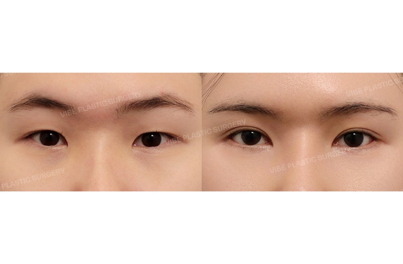 ดวงตาคมชัดด้วยการแก้ตาสองชั้นและเปิดหางตา 4 ทิศทาง! โดย นพ. ยูยองมุน Vibe Plastic Surgery สถานีชินนนฮยอน