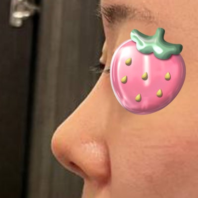 짧아진 코, 다시 길게 만들 수 있을까? (자가늑연골 코성형) by 신논현역 바이브 성형외과 유영문 원장 사진 7