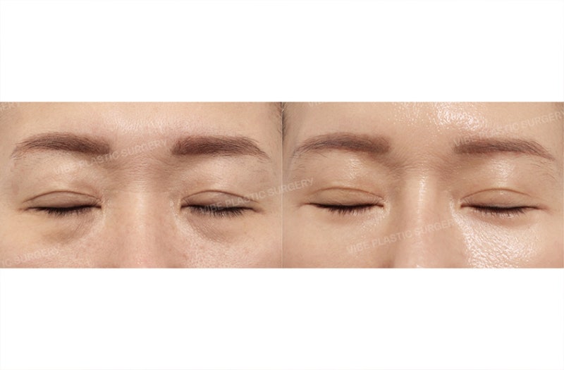 50대 눈성형, 눈썹하거상과 하안검을 함께 해야 하는 경우는? by 신논현역 바이브 성형외과 유영문 원장 사진 3