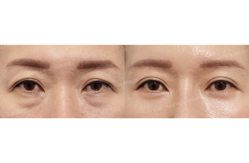 50대 눈성형, 눈썹하거상과 하안검을 함께 해야 하는 경우는? by 신논현역 바이브 성형외과 유영문 원장