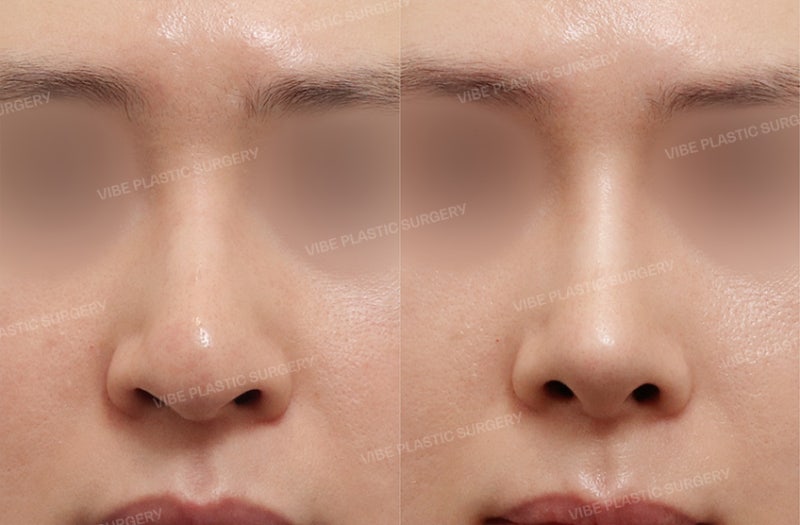 심하게 휘어지고 숨쉬기 불편한 코 ! 이물질 없이 "자가늑연골" 만으로 바로잡은 30대 남성 코성형 케이스 by 신논현역 바이브 성형외과 유영문 원장