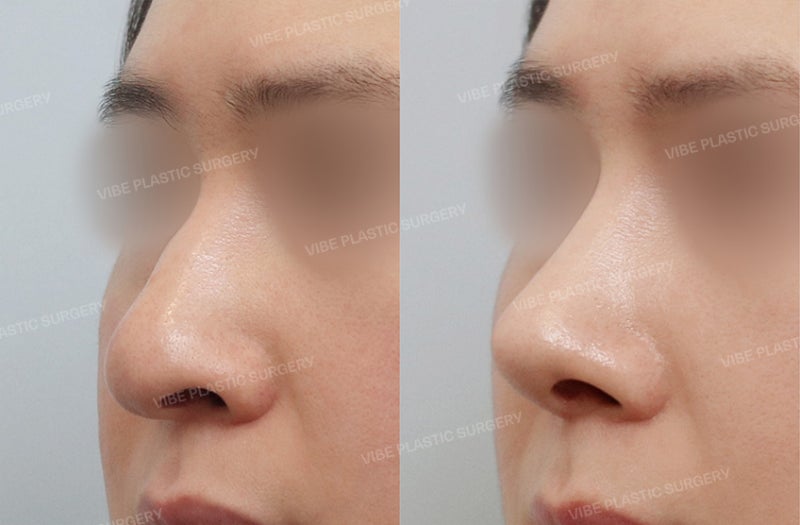 심하게 휘어지고 숨쉬기 불편한 코 ! 이물질 없이 "자가늑연골" 만으로 바로잡은 30대 남성 코성형 케이스 by 신논현역 바이브 성형외과 유영문 원장 사진 2