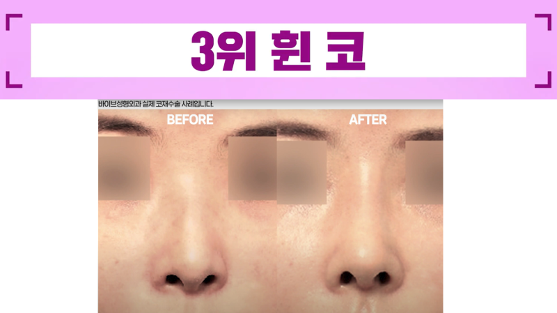 코재수술 하는 이유 BEST5 알려드립니다!