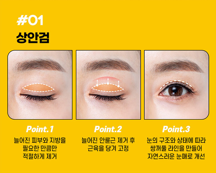 바이브성형외과 에서 상안검수술에 대해 알려드립니다!