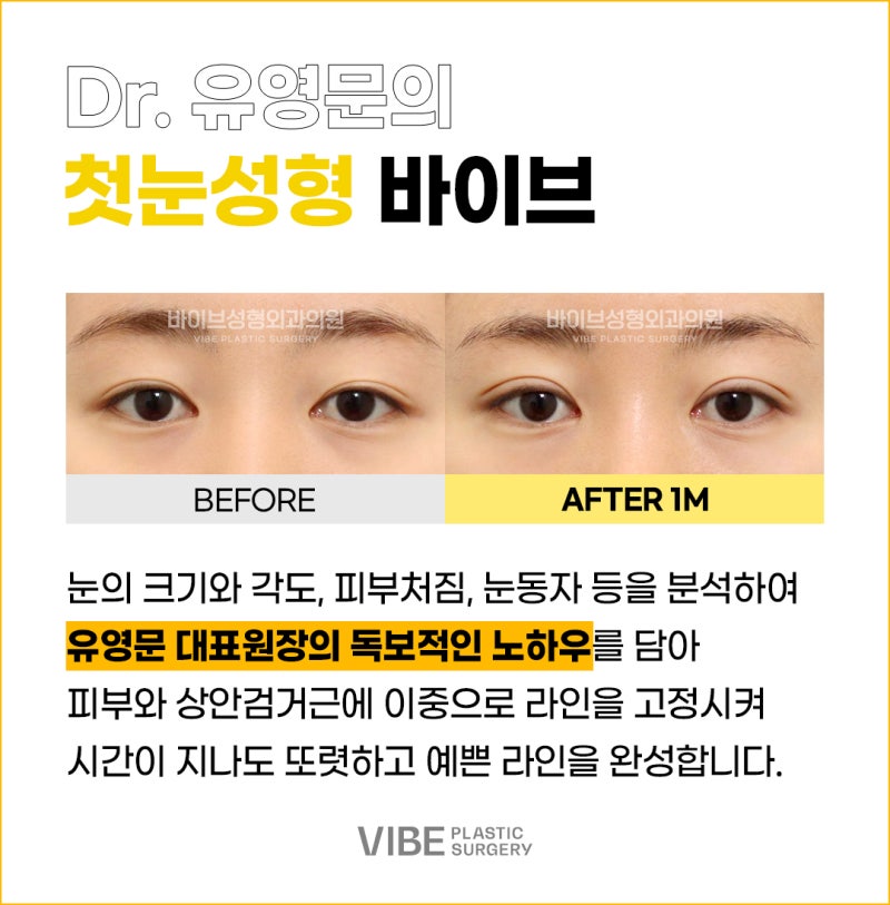 강남눈성형유명한곳 바이브에서 첫눈성형하고 예뻐지세요:)