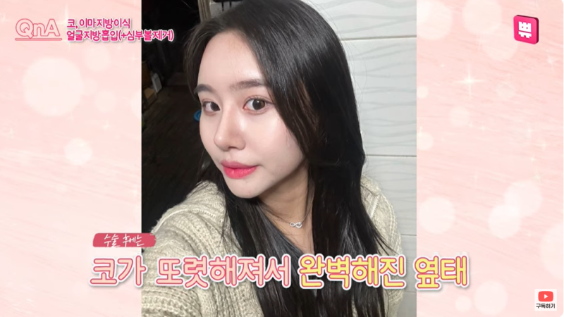 Absolute Highest Surgical Satisfaction! Maru's Plastic Surgery Review Part 2, Adding Maturity After Surgery at Vibe!