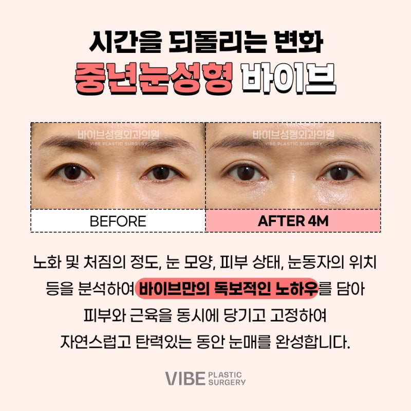 강남중년눈성형잘하는곳 바이브에서 더 젊어진 모습을 만나보아요^^