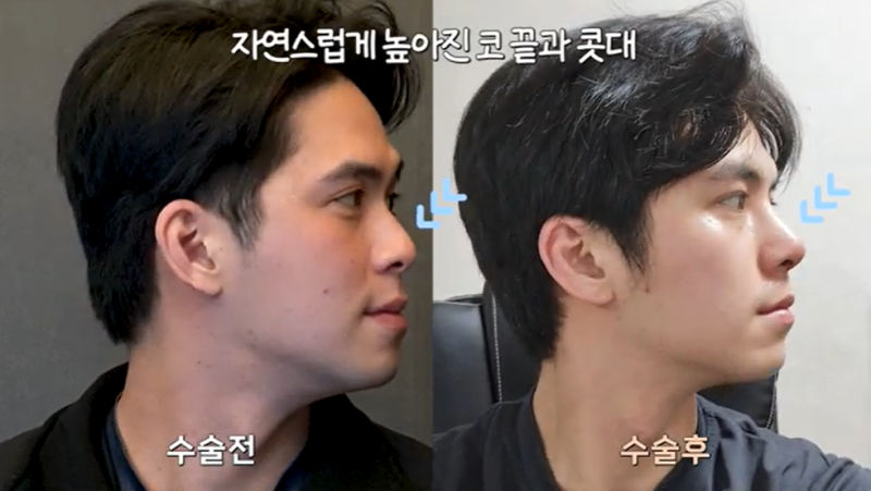 남자코성형잘하는곳 바이브 간판모델 도전하는 건창님의 리얼후기 1탄!