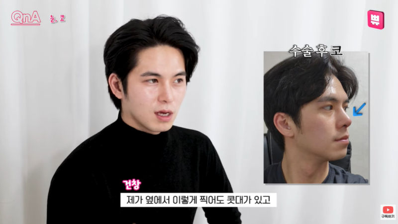 강남 남자 코성형 잘하는곳 바이브에서 눈, 코 수술한 건창님 리얼후기 2탄!