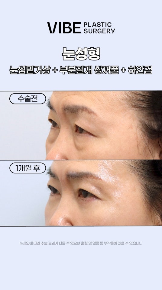 눈처짐개선고민? 중년눈성형으로 개선