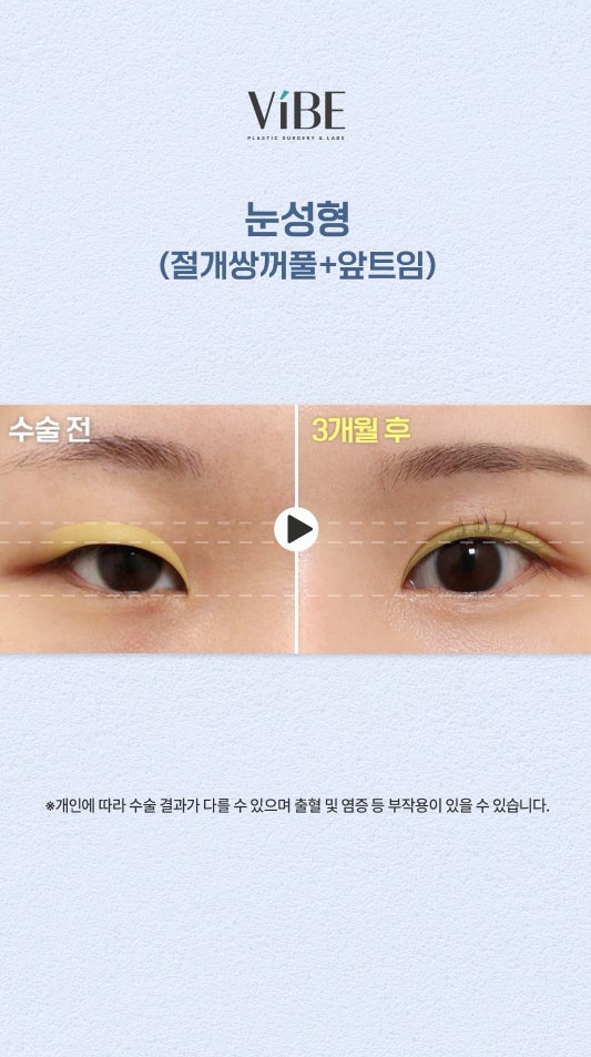 쌍액으로 만들었던 쌍꺼풀, 절개법과 앞트임으로 쌍액탈출