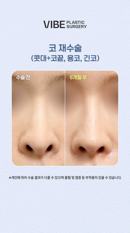 เคสศัลยกรรมแก้จมูก ทรงจมูกมังกรและจมูกยาว