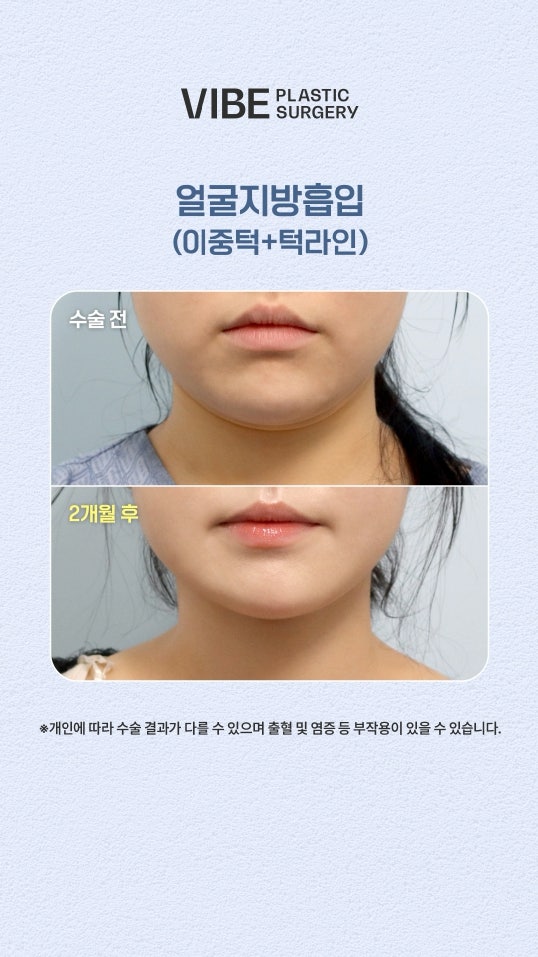 얼굴지방흡입 엘싸(LSSA)로 브이라인 완성