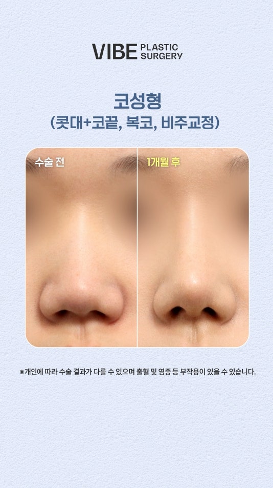 낮은코&복코 유형, 날렵한 직반라인으로 변신하기