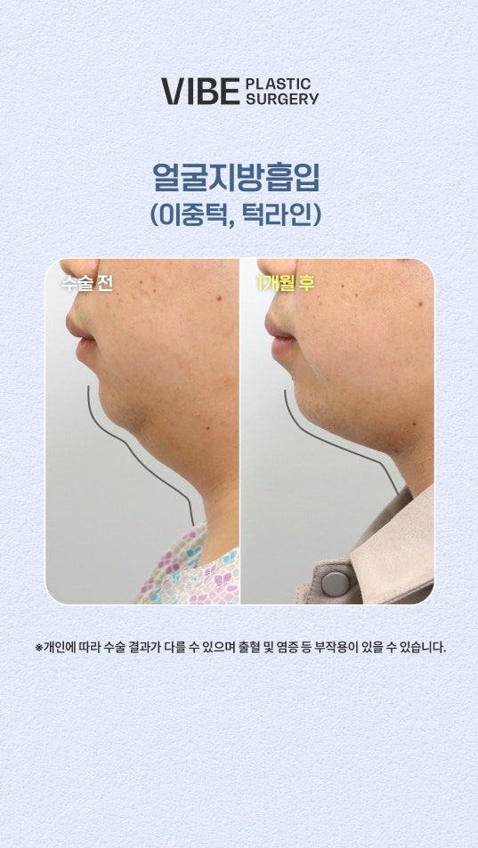 กำจัดไขมันเหนียงใต้คางอย่างหมดจดด้วยการดูดไขมันแบบไม่ผ่าตัด LSSA