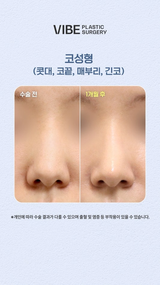 ปลายจมูกยาวและหย่อนคล้อย สวยงามโดยไม่ต้องใช้ซิลิโคน