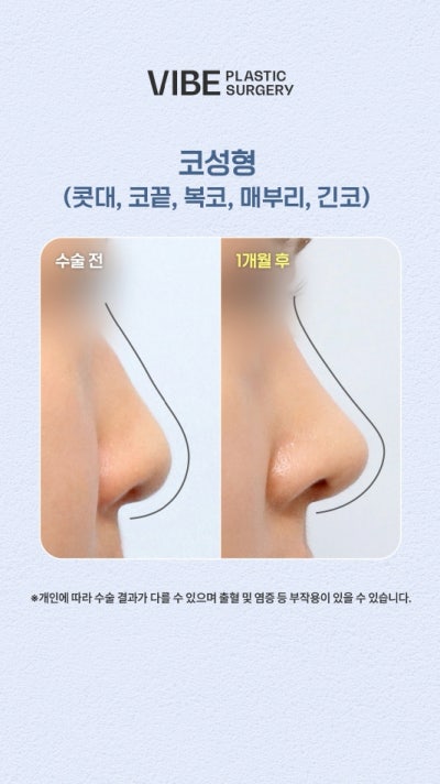 การแก้ไขจมูกชมพู่ + จมูกเหยี่ยว + จมูกยาว ก่อนและหลัง