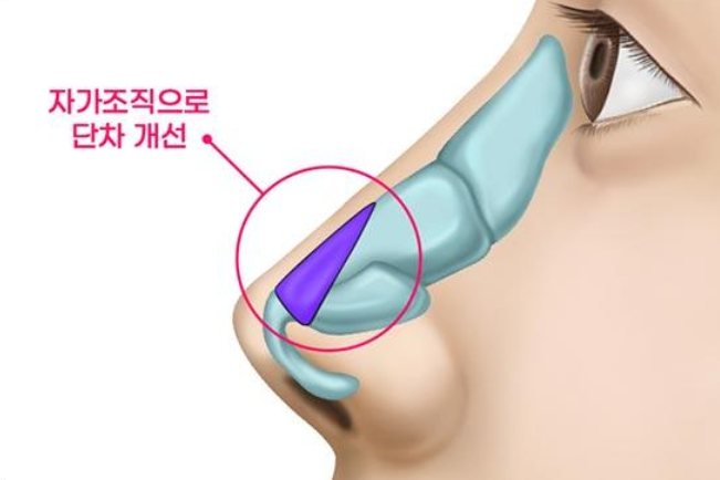ศัลยกรรมจมูกกังนัม ศัลยกรรมจมูกแบบไร้ซิลิโคน ต้องที่ Vibe Plastic Surgery