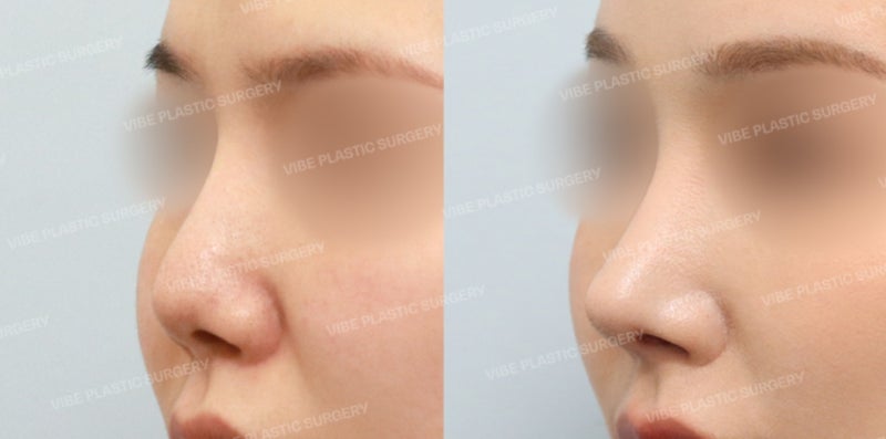 Sinnonhyeon Revision Rhinoplasty: Why Should You Be More Careful Than Your First Surgery? Gangnam Rhinoplasty Vibe Plastic Surgery Explains