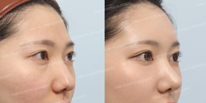 Sinnonhyeon's Best Rhinoplasty Clinic 🌿 | Why Implant-Free Rhinoplasty is Possible with Just Cartilage at Vibe Plastic Surgery?