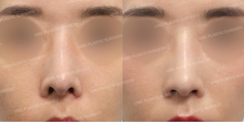 👃🏻 Alar Lowering: What Kind of Nose Needs This Surgery? | Easily Explained by the Famous Plastic Surgery Clinic, Vibe Plastic Surgery