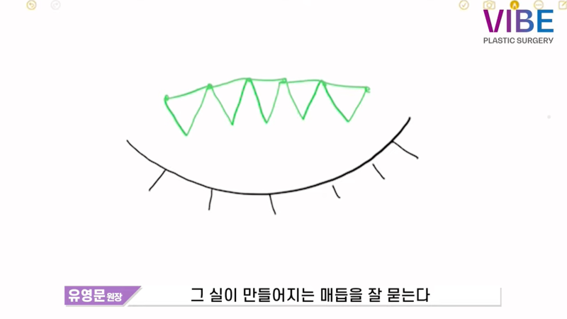쌍꺼풀 수술 방법 총정리｜비절개·매몰법·자연유착·부분절개·절개 차이