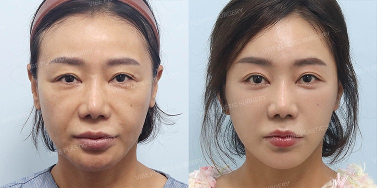 비온뒤 의학채널 출연‍⚕️동안 얼굴의 핵심, 이마·눈·턱선 리프팅｜신논현성형외과 바이브성형외과