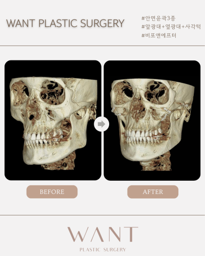 강남 안면윤곽 잘하는곳 찾는다면 사진 5