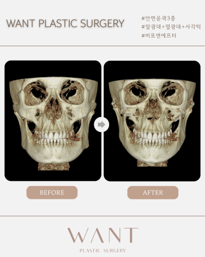 조화로운 안면윤곽 결과를 위한 사진 6